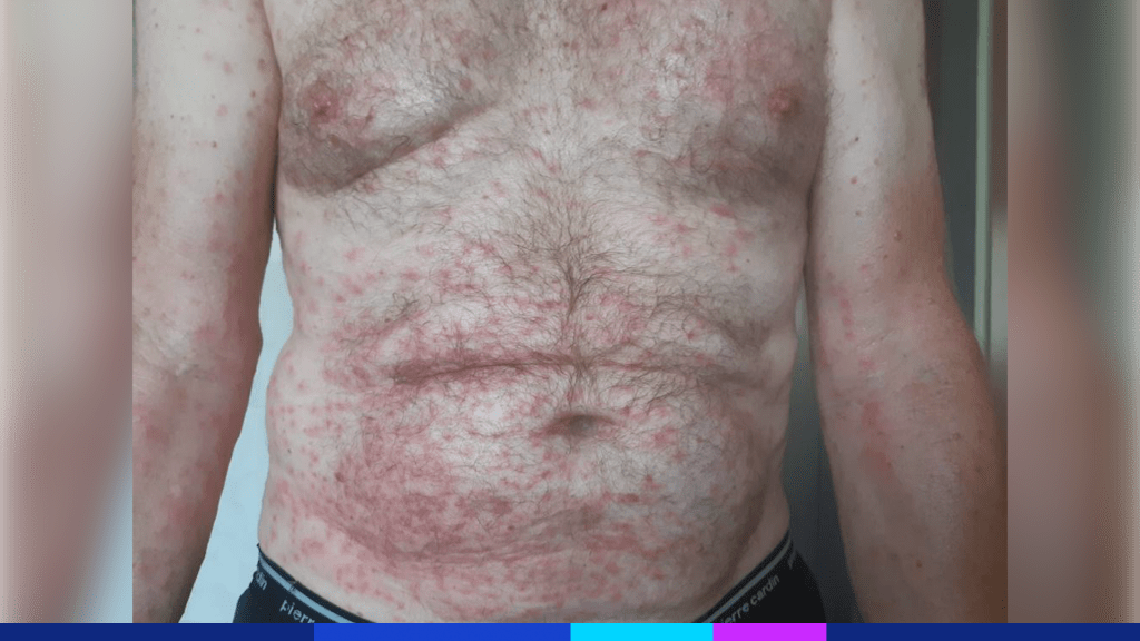 Gefährliche Goldafter-Raupe verbreitet sich in der Schweiz